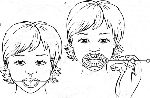 [Наталья Лабутина] Коррекция межзубного произношения с использованием миофункционального подхода
